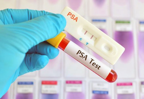 What Is Psa Test?